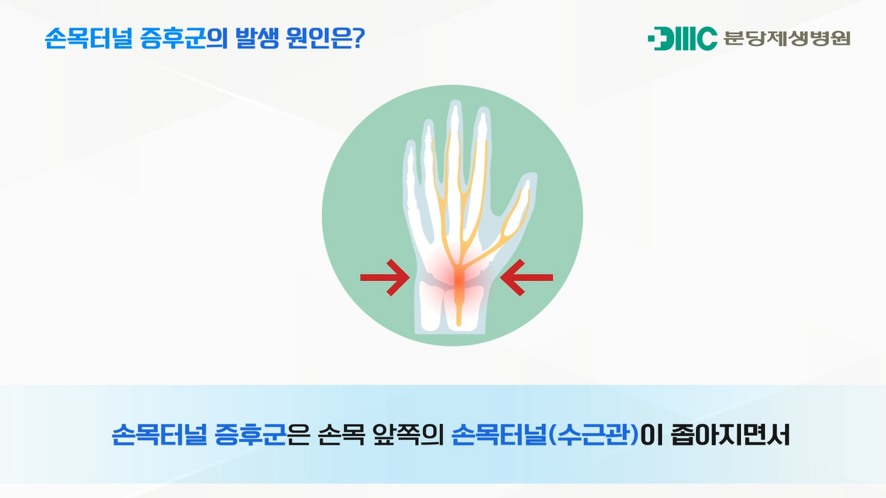 손목터널증후군(손목통증,손저림)